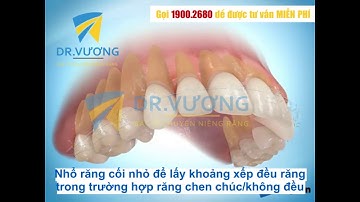 Niềng răng chen chúc có nhổ răng