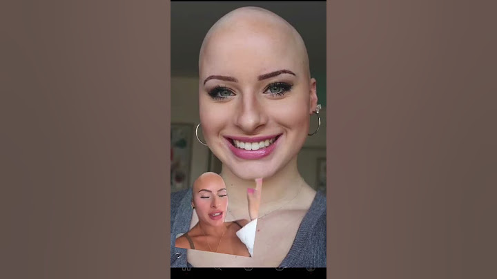 The way my face & hair changed each year #hairloss #alopecia #bald #alopeciaawareness #viral