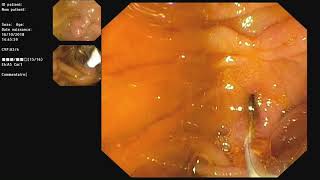 Extraction de lithiases bilaires par CPRE