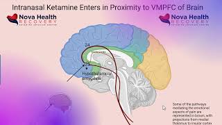Micro dosing ketamine and ketamine home therapy for depression - Nothing to sneeze at! Does it work?