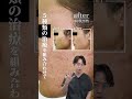 ニキビ跡治療▶30代男性（重度ニキビ跡の治療法）
