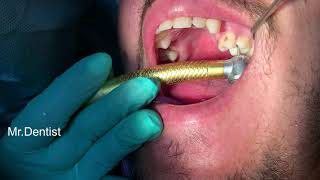 Tooth Ache - Root Canal Treatment  [ When The Patient Shows Up In Pain ]