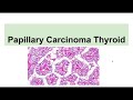 Papillary Carcinoma Thyroid