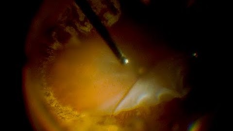 Navigating Complex Retinal Detachments PVR, Shortening, and Macula Involvement