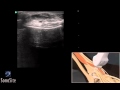 3d cmo hacer examen ecogrfico del tendn extensor del tobillo  ecgrafo de sonosite