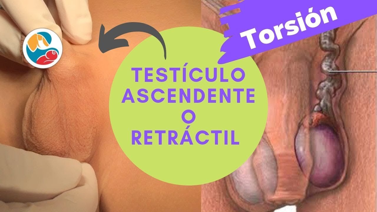 TESTICULOS ASCENDENTES O RETRACTILES GRAN RIESGO DE TORSION ensenada cruise