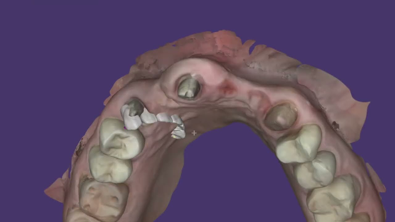 Como realizar una planeación y diseño de guía quirúrgica en Exocad de forma fácil y efectiva