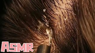 ASMR immersion | how to do head itching, see how to solve the little sister, a trick to solve scalp