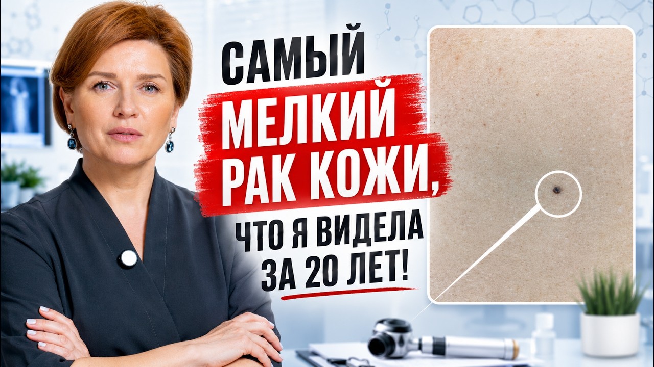 ЭТО НЕ РОДИНКА! Как не пропустить МЕЛАНОМУ? Этот ролик может вас спасти! — Transcript