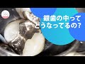 銀歯の中に虫歯を発見‼︎ Found Cavities Under Silver Teeth Through X-rays!