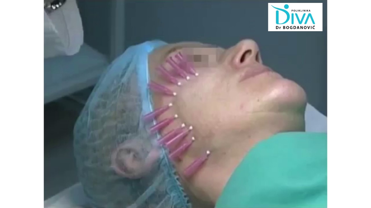 Podmlađivanje lica pomoću 3D mezoniti - poliklinika DIVA