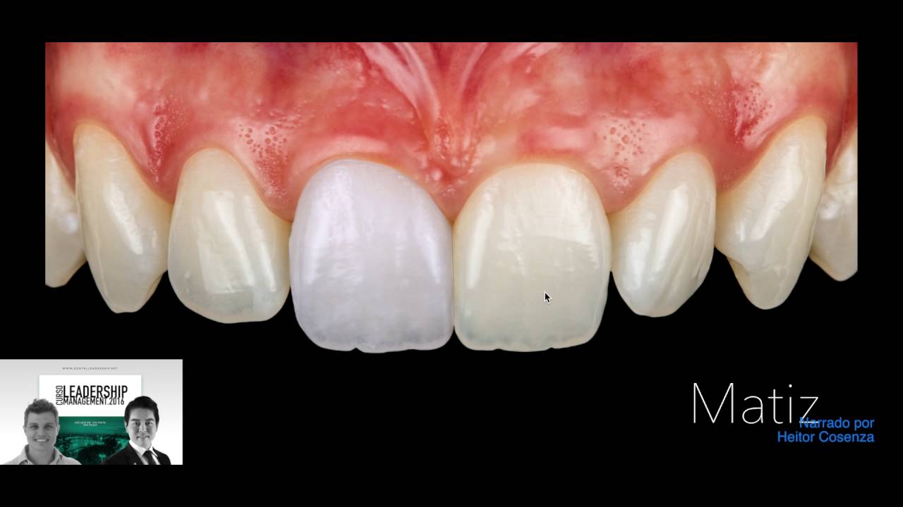 Como tirar cor dos dentes passo-a-passo - uso da escala Vita Master 3D