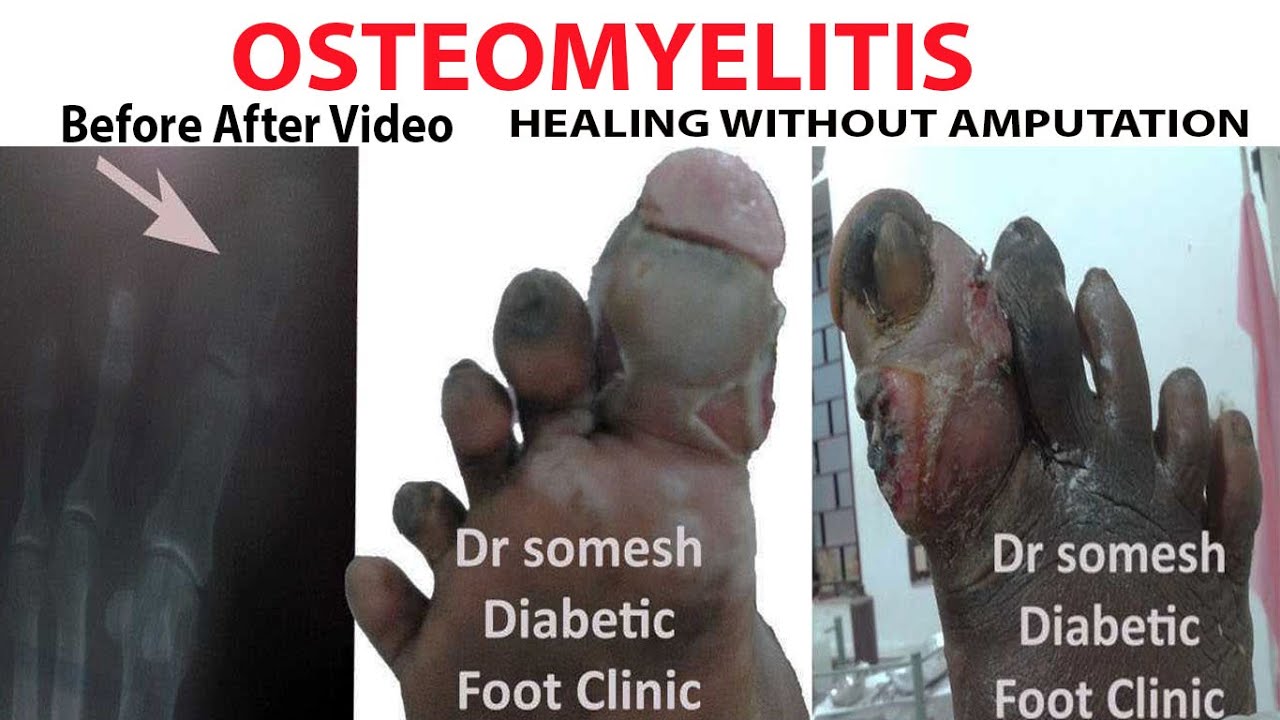 Osteomyelitis Healing Without Amputation Podiatristchennai Youtube