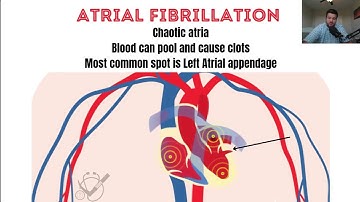 What Causes Stroke in Atrial Fibrillation (Afib)?