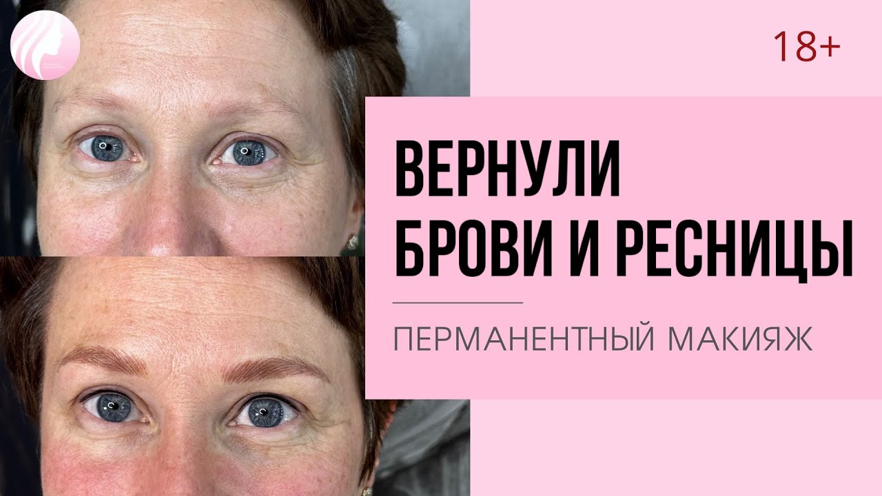 БРОВИ АЛОПЕЦИЯ. Имитация волосков бровей - YouTube