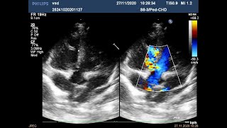 Ехо КГ з аналізом  перимембранозний дефект міжшлуночкової перетинки
