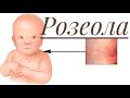 Розеола қазақша/ Вирусты экзантема/ Вирусты бөртпе