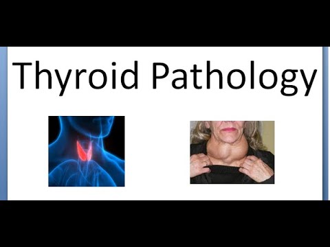 Pathology 809 Thyroid Conditions Thyroiditis Tumor Benign Carcinoma Cancer Neoplasm difference