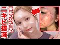 繰り返すニキビ肌を治した最近の私のスキンケア！