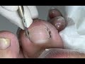 Huge relief for thick nail(Nail skill teaching)