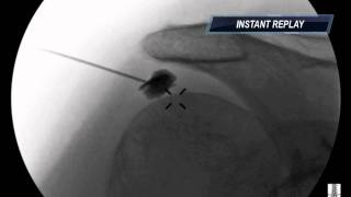 Subacromial Injection under Fluoroscopy - ThePainSource.com