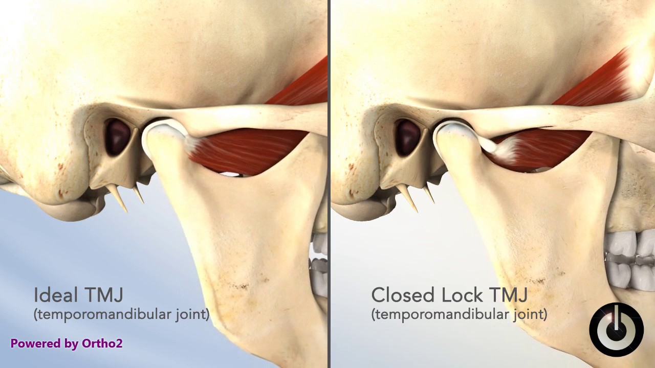 TMJ Closed Lock YouTube