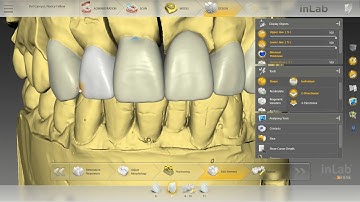 Anterior CAD Design on Sirona InLab 18