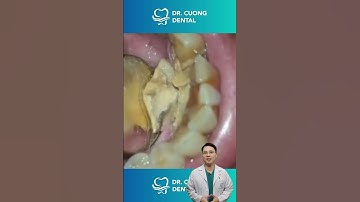 Miếng cao răng khổng lồ |Dr Cường Official
