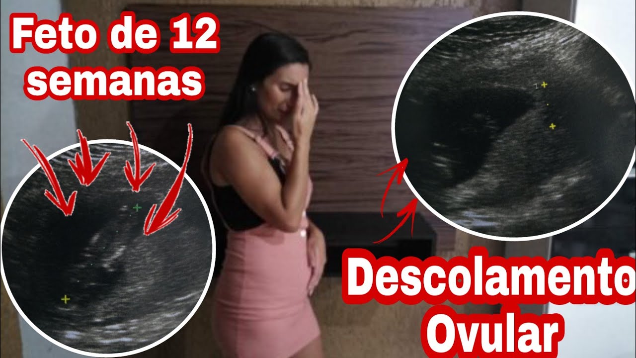 O Que é Descolamento Ovular - BRAINCP
