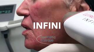 LARGEST USER IN US OF: Infini Microneedling RF Device
