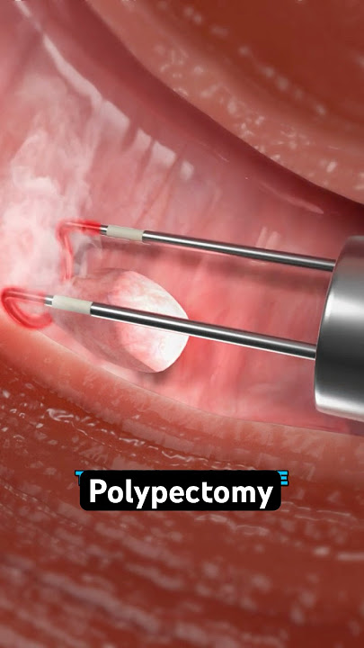 Removing a polyp from your uterus (3D Animation)