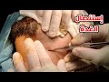 شاهد عملية استئصال الغدة الدرقية 