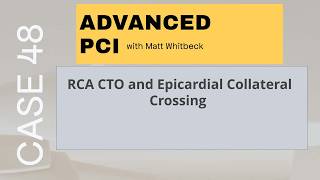 CAE 48 RCA CTO and Epicardial Collateral Crossing