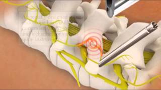 Endoscopic Rhizotomy | Spine Institute of North America