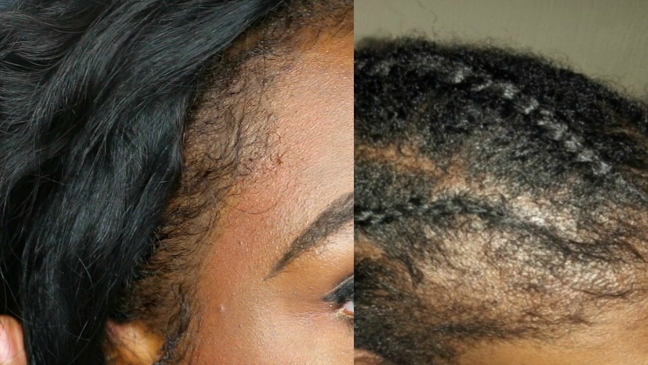 Image result for hair loss vs natural hair thinning