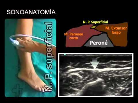 Tratamiento del edema cerebral