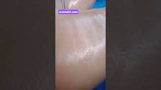 sarap.kejefit.darah.sumbat.menyebar.bagian.paha