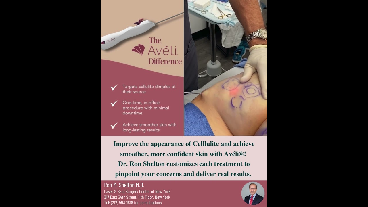 Aveli for cellulite reduction in NYC | Dr Ron Shelton 