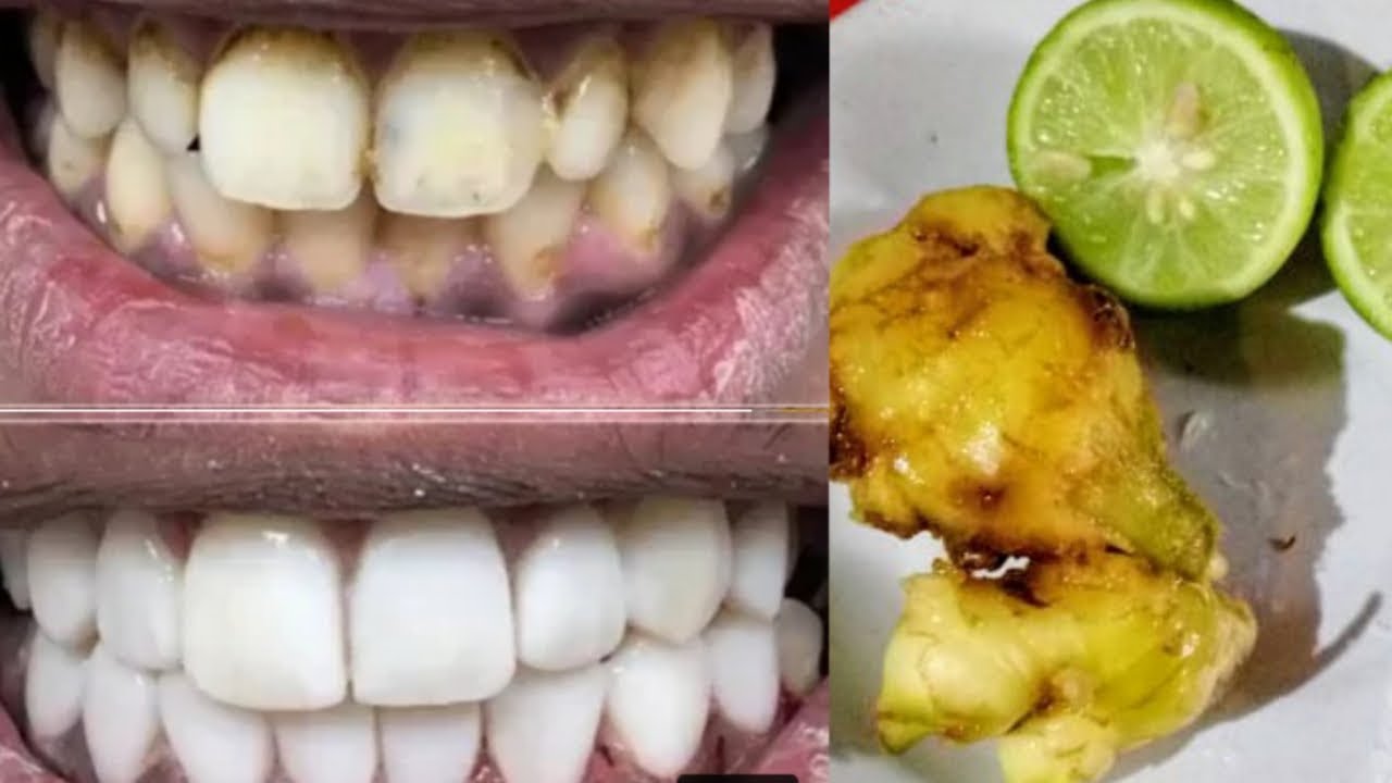 Teeth Cleaning In Malayalamപല്ലിലെ കറ പെട്ടന്ന് കളയാംTeeth