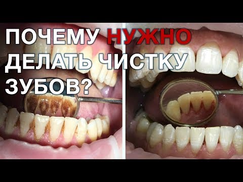 Что такое зубной камень? Как удаляют зубной камень?