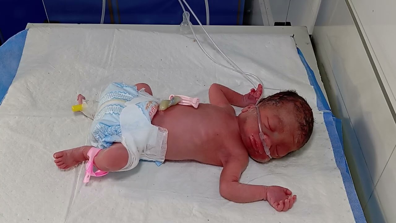 Very pre term baby and very respiratory distress 