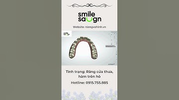 Phác đồ niềng răng thưa, hô - Smilesalign Việt Nam