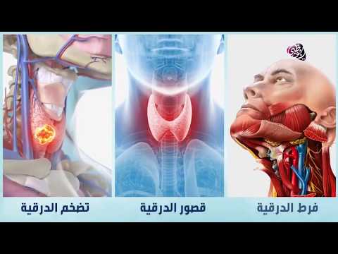 فيديو: ما هي الغدة الدرقية الخطرة؟