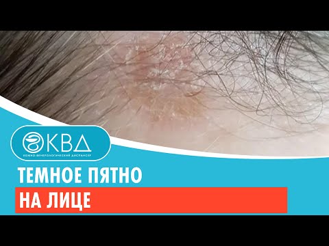 😐 Темное пятно на лице. Клинический случай №326