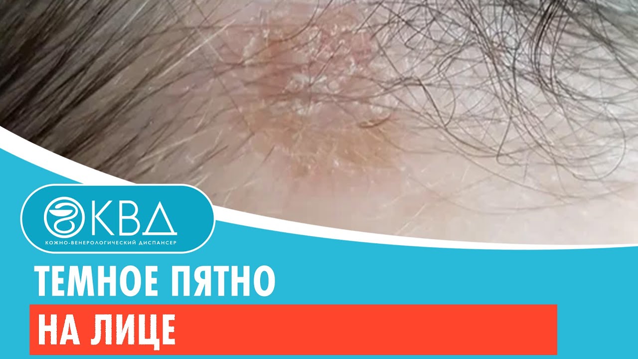 😐 Темное пятно на лице. Клинический случай №326 - YouTube