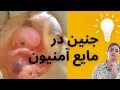 مایع آمنیون مایع آمنیون در جنین کاهش آمنیون افزایش آمنیون مایع آمنیون مایع آمنیون در جنین کاهش آمنیون افزایش آمنیون
