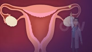 ما هي أسباب الحمل خارج الرحم؟