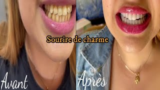 عدسات الآسنان بالكمبوزيت قبل وبعد فيديوA3 facettes composite avants et après