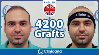 Mr. Hani Share His Experience After Hair Transplant Operation.