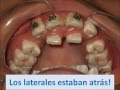 Avance de caso de ortodoncia, laterales en segunda fila